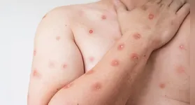 Caso de Mpox é confirmado em Porto Alegre. Veja os sintomas da doença e como se prevenir!