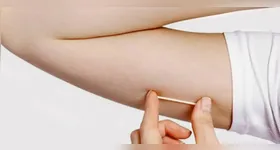 Pará: implante contraceptivo que custa até R$ 4 mil é incorporado no SUS.