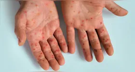 Vírus voltou a gerar dúvidas nas buscas na internet sobre diagnóstico e tratamento