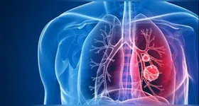 A tuberculose é causada pela bactéria Mycobacterium tuberculosis, transmitida principalmente pelo ar, quando uma pessoa infectada tosse, espirra ou fala.