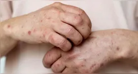 As lesões cutâneas representam o principal sinal clínico da mpox. O processo de evolução dessas marcas segue etapas bem definidas.