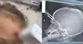 Exame de raio-X mostra o objeto cravado na testa da criança