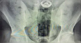 Médico mostra raio-X em que mostra o desodorante introduzido