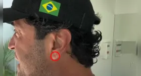 Sinal foi observado na orelha do influenciador Henrique Maderite, após ter sua morte confirmada em decorrência de um infarto.