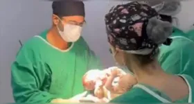 Caso classificado como raro mobilizou equipe médica especializada desde o nascimento dos gêmeos siameses Marcos e Mateus.