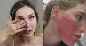 Aspecto da pele é uma reação normal após procedimentos estéticos realizados recentemente pela influenciadora.