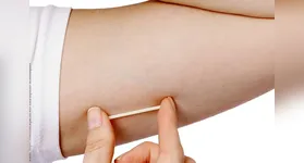 O Implanon é um importante método contraceptivo.