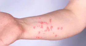 Imagem ilustrativa da notícia Sobe para 140 número de casos confirmados de Mpox no Brasil