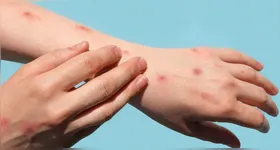 Após o pico registrado entre 2022 e início de 2023, a Mpox – anteriormente chamada de monkeypox – segue sob monitoramento das autoridades sanitárias.