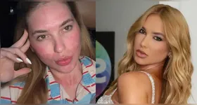 Virginia exibe rosto avermelhado após procedimentos estéticos e comenta recuperação nas redes sociais.