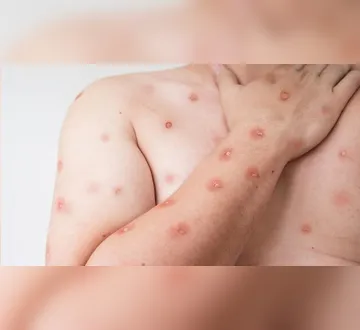 Imagem ilustrativa da imagem Caso de Mpox é confirmado em Porto Alegre; veja sintomas e cuidados