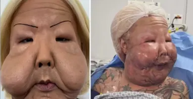 Imagem ilustrativa da imagem Juju do Pix faz nova cirurgia para retirar óleo mineral do rosto