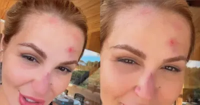 Deolane Bezerra mostra ferimentos após acidente doméstico e alerta seguidores sobre cuidados dentro de casa.