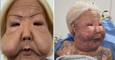 Juju do Pix durante mais uma etapa do tratamento para corrigir sequelas deixadas por procedimento estético clandestino.