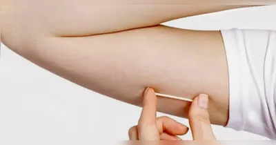 Pará: implante contraceptivo que custa até R$ 4 mil é incorporado no SUS.