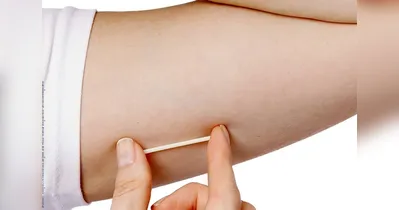 O Implanon é um importante método contraceptivo.