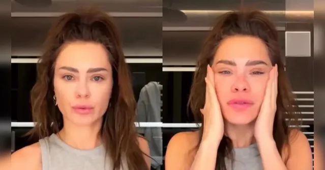 Imagem ilustrativa da notícia Dermatologista explica mudanças no rosto de Carolina Dieckmann