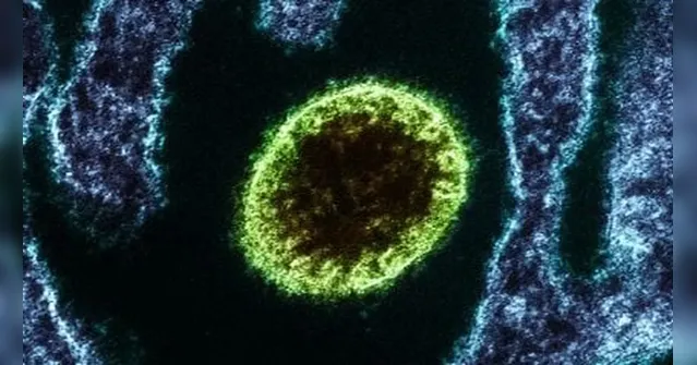 Imagem ilustrativa da notícia Nipah: conheça o vírus com alta mortalidade que causou surto na Índia