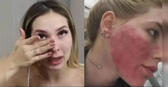 Imagem ilustrativa da notícia Virgínia aparece com rosto avermelhado e assusta fãs na web