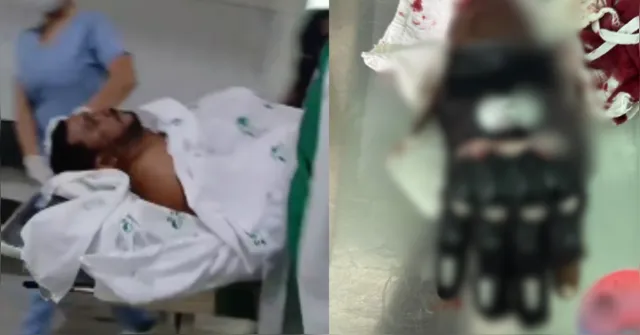 Imagem ilustrativa da notícia Mototaxista tem mão amputada após agressão com facão em Castanhal