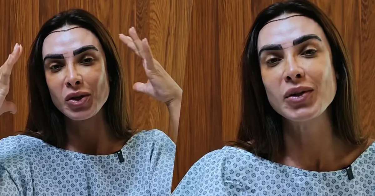 Nicole Bahls passou por transplante capilar após diagnóstico de alopecia androgenética e compartilhou detalhes do procedimento nas redes sociais.