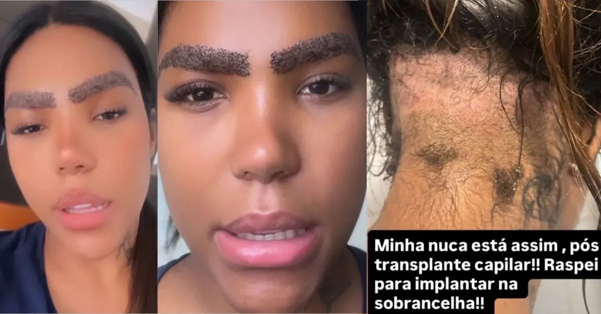 Carol Lekker exibiu a nuca raspada nas redes sociais e explicou que a mudança faz parte da recuperação de um transplante de sobrancelha.