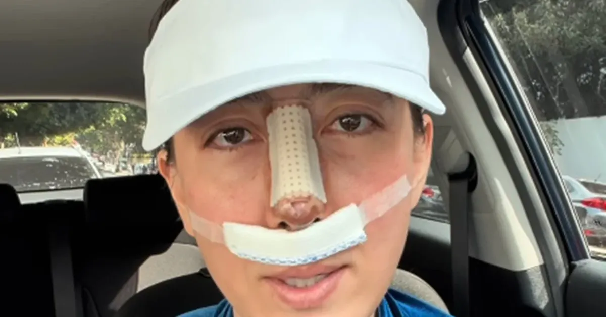 Juliane Massaoka compartilhou com os seguidores detalhes da recuperação após enfrentar complicações decorrentes do uso de PMMA durante uma rinoplastia realizada na adolescência.