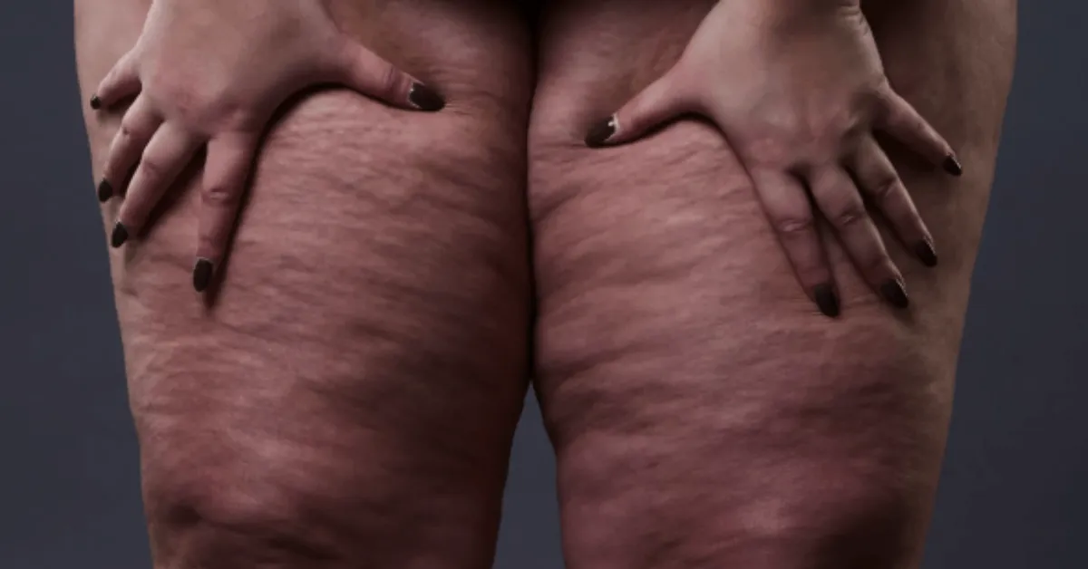 Campanha do Junho Roxo chama atenção para sintomas, diagnóstico e tratamento do lipedema, doença que afeta principalmente mulheres.