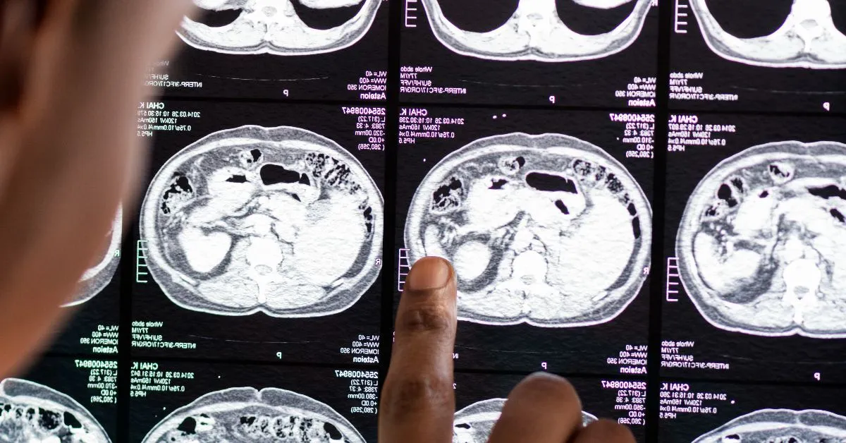 Pesquisa avaliou 2.410 idosos com mais de 65 anos e comparou os hábitos de sono dos participantes com os níveis da proteína tau, associada ao Alzheimer.