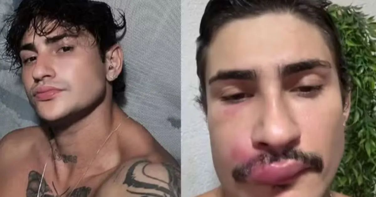 Influenciador foi internado após espreme uma espinha na região do "triângulo da morte".