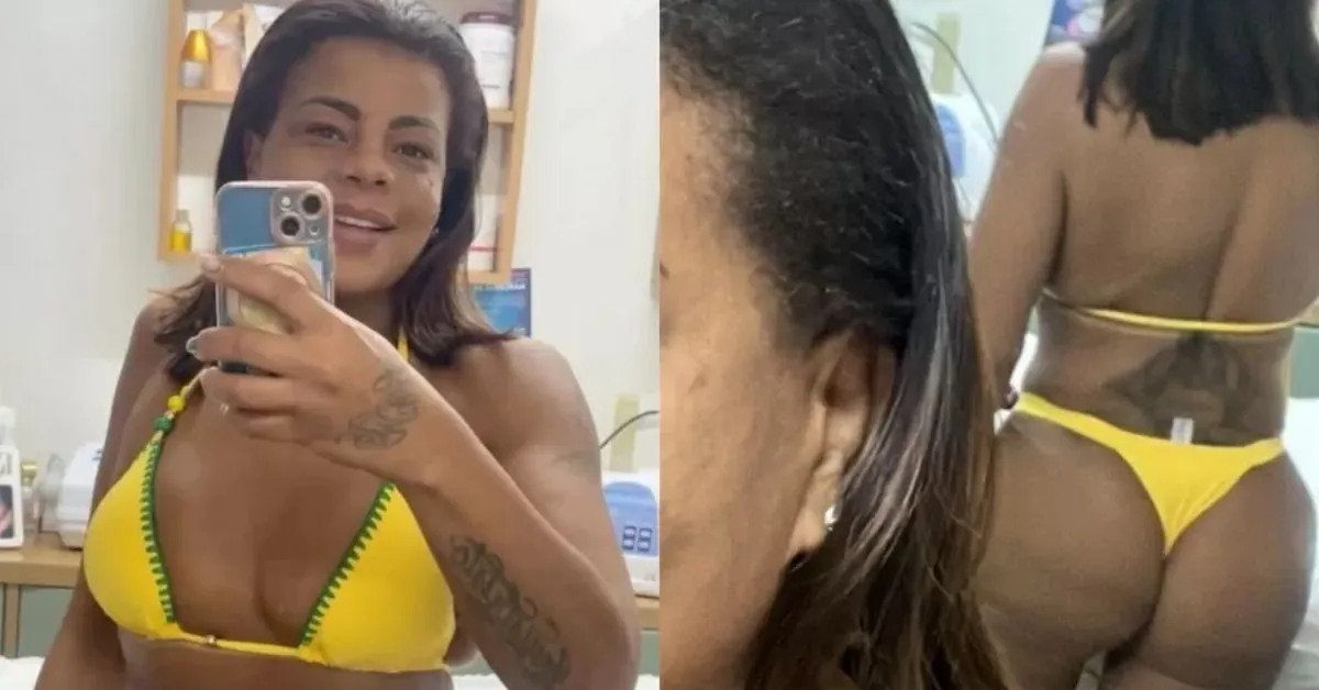 Com um biquini nas cores verde e amarelo, ela registrou o resultado do procedimento estético no bumbum.