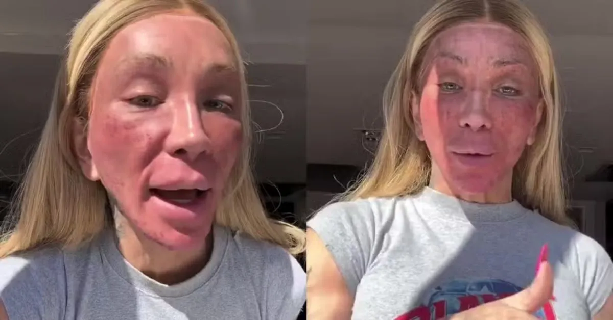 O peeling escolhido pela influenciadora é um procedimento bastante conhecido no universo da estética.