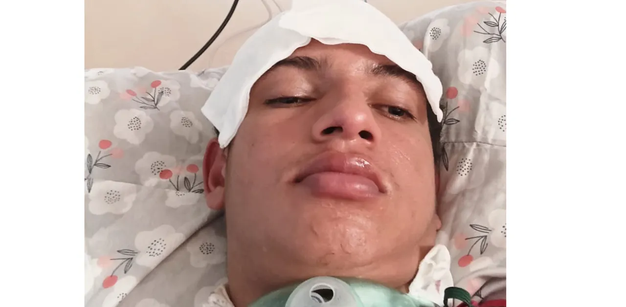 Família busca apoio para que jovem passe por procedimento especializado e possa recuperar a respiração pelo nariz.