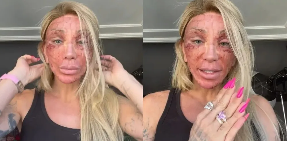 Maya Massafera surpreendeu os seguidores após surgir com o rosto completamente avermelhado depois do processo de recuperação do Laser de CO2.