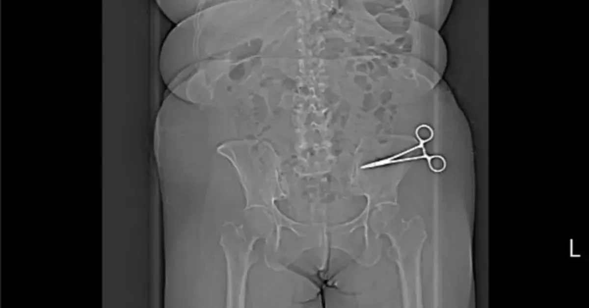 "É um milagre ela estar viva", diz família após mulher descobrir tesoura cirúrgica esquecida no abdômen sete meses depois de abdominoplastia na Itália.