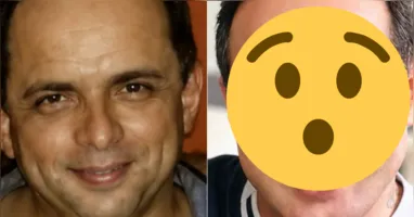 Esdras de Souza compartilhou nas redes sociais o resultado dos procedimentos estéticos realizados no rosto e recebeu elogios dos seguidores.
