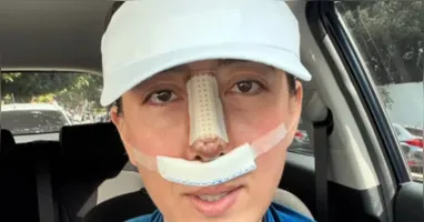 Juliane Massaoka compartilhou com os seguidores detalhes da recuperação após enfrentar complicações decorrentes do uso de PMMA durante uma rinoplastia realizada na adolescência.
