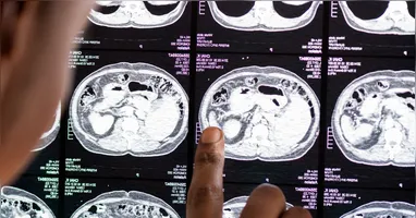 Pesquisa avaliou 2.410 idosos com mais de 65 anos e comparou os hábitos de sono dos participantes com os níveis da proteína tau, associada ao Alzheimer.