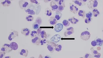 Saiba mais sobre a ameba comedora de cérebros e os riscos após morte em Rondônia. Entenda como evitar infecções e a relação com mudanças climáticas.