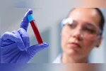 O Galleri é um teste de rastreio multicâncer, termo preferido pelos oncologistas ao invés de biópsia líquida, embora os dois signifiquem a mesma coisa.