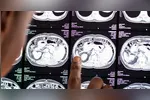 Pesquisa avaliou 2.410 idosos com mais de 65 anos e comparou os hábitos de sono dos participantes com os níveis da proteína tau, associada ao Alzheimer.