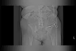 "É um milagre ela estar viva", diz família após mulher descobrir tesoura cirúrgica esquecida no abdômen sete meses depois de abdominoplastia na Itália.