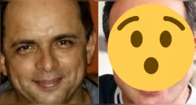 Esdras de Souza compartilhou nas redes sociais o resultado dos procedimentos estéticos realizados no rosto e recebeu elogios dos seguidores.