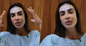 Nicole Bahls passou por transplante capilar após diagnóstico de alopecia androgenética e compartilhou detalhes do procedimento nas redes sociais.