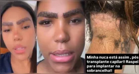 Carol Lekker exibiu a nuca raspada nas redes sociais e explicou que a mudança faz parte da recuperação de um transplante de sobrancelha.