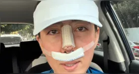 Juliane Massaoka compartilhou com os seguidores detalhes da recuperação após enfrentar complicações decorrentes do uso de PMMA durante uma rinoplastia realizada na adolescência.