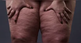 Campanha do Junho Roxo chama atenção para sintomas, diagnóstico e tratamento do lipedema, doença que afeta principalmente mulheres.