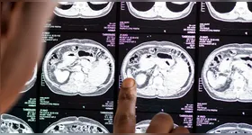 Pesquisa avaliou 2.410 idosos com mais de 65 anos e comparou os hábitos de sono dos participantes com os níveis da proteína tau, associada ao Alzheimer.