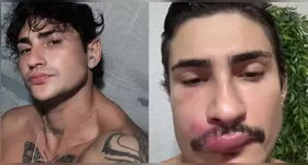 Influenciador foi internado após espreme uma espinha na região do "triângulo da morte".