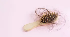A alopecia fibrosante frontal é uma das doenças que tem ligaçãoi direta com o uso de anticoncepcionais.